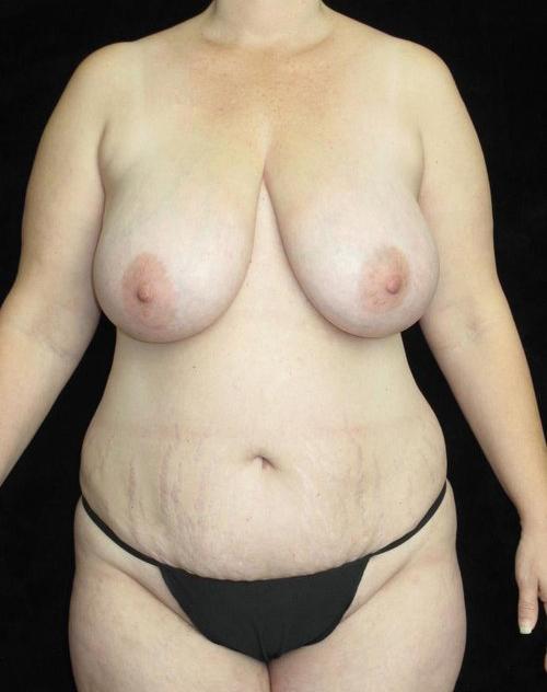 Breast lift with Augmentation Patient Photo - Case 83 - before view-0
