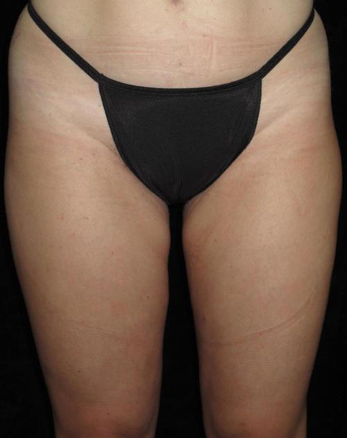 Liposuction Patient Photo - Case 59 - after view-1