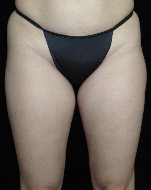 Liposuction Patient Photo - Case 59 - before view-1