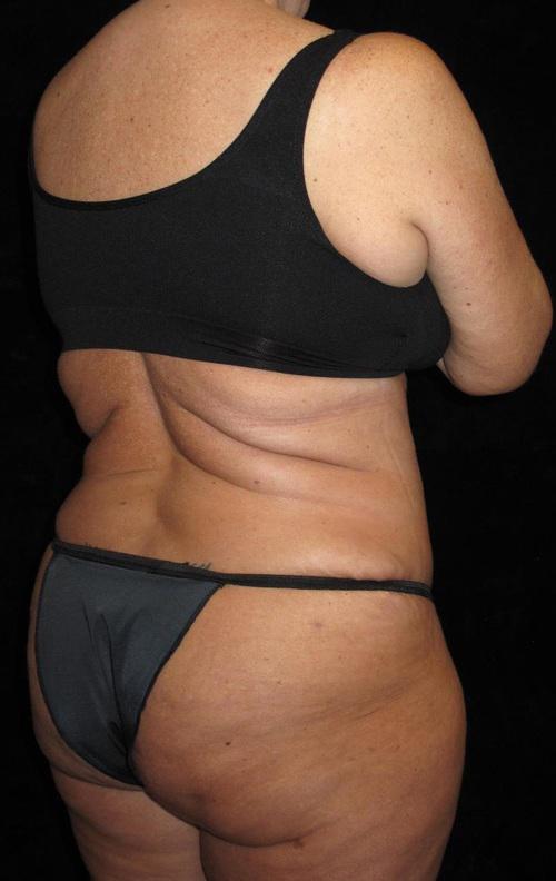 Liposuction Patient Photo - Case 45 - after view-1
