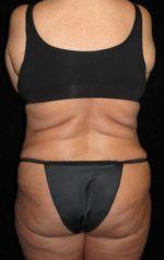 Liposuction - Case 45 - After