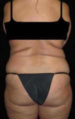 Liposuction - Case 45 - Before