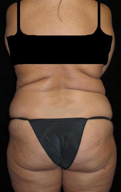 Liposuction Patient Photo - Case 45 - before view-0