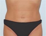 Liposuction - Case 86 - After