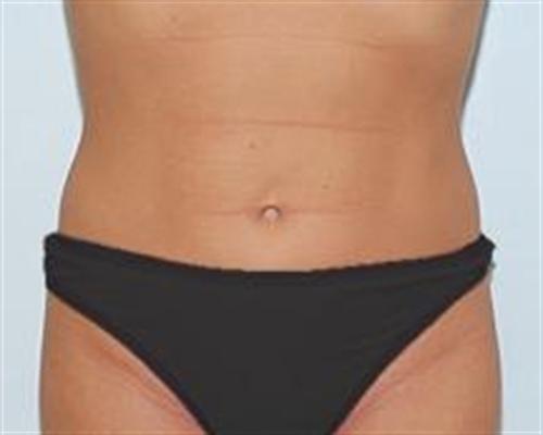 Liposuction Patient Photo - Case 86 - after view-0