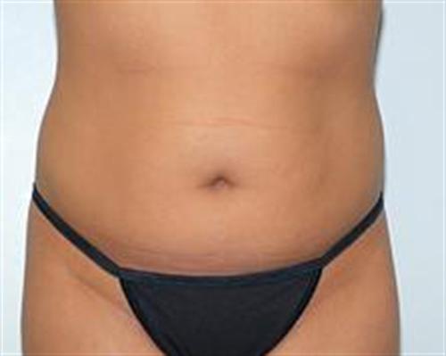 Liposuction Patient Photo - Case 86 - before view-