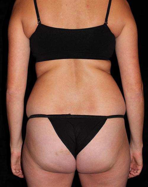 Liposuction Patient Photo - Case 194 - before view-3