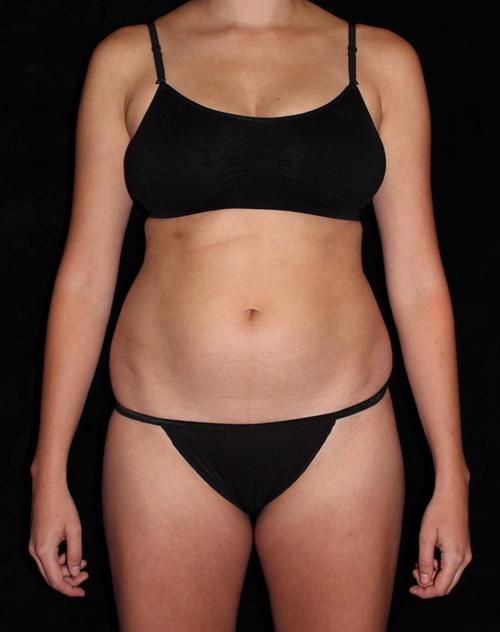 Liposuction Patient Photo - Case 194 - before view-