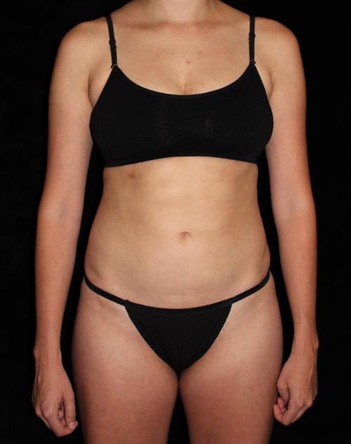 Liposuction Patient Photo - Case 194 - after view