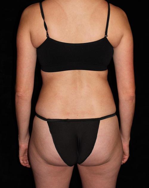 Liposuction Patient Photo - Case 194 - after view-3