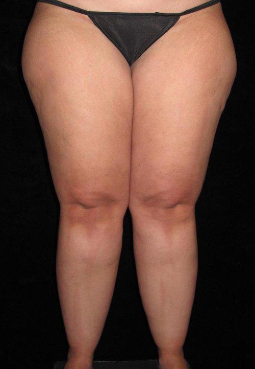 Liposuction Patient Photo - Case 80 - before view-