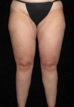 Liposuction - Case 80 - After