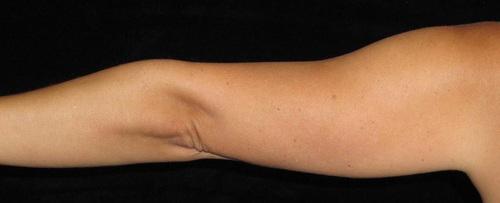 Liposuction Patient Photo - Case 73 - after view