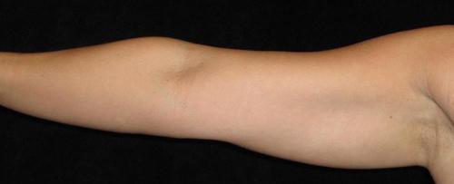 Liposuction Patient Photo - Case 73 - before view-1