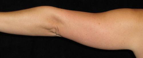 Liposuction Patient Photo - Case 73 - before view-