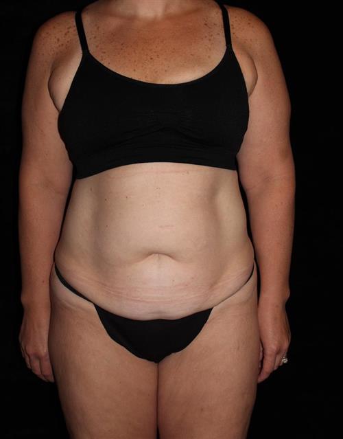 Body Lift Patient Photo - Case 213 - before view-