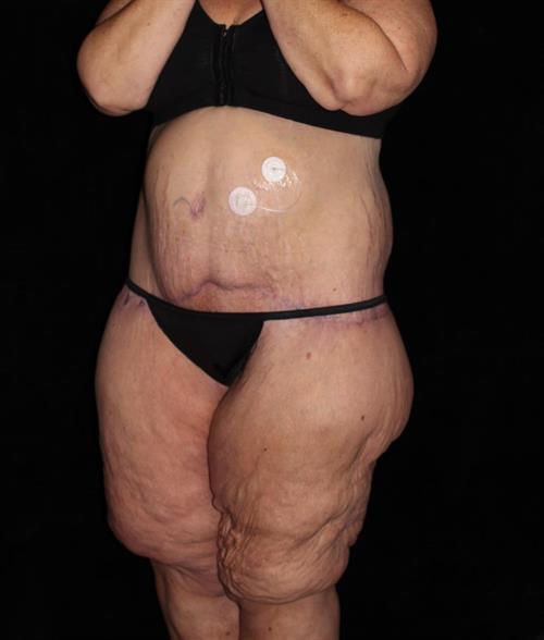 Body Lift Patient Photo - Case 215 - after view