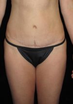 Liposuction - Case 70 - After