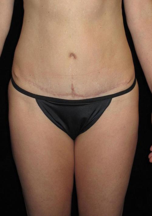 Liposuction Patient Photo - Case 70 - after view-0