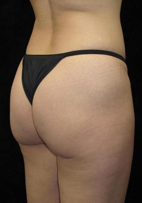 Liposuction Patient Photo - Case 70 - before view-1