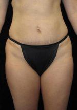 Liposuction - Case 70 - Before