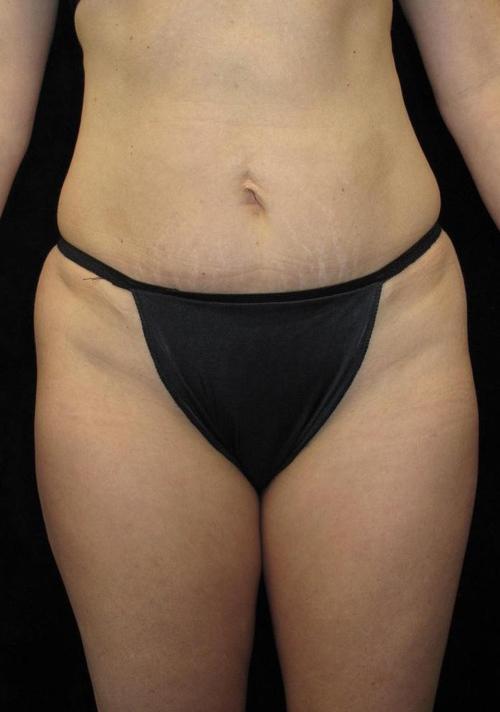 Liposuction Patient Photo - Case 70 - before view-