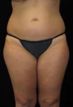 Liposuction - Case 69 - Before