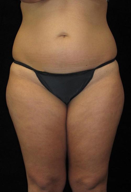 Liposuction Patient Photo - Case 69 - before view-