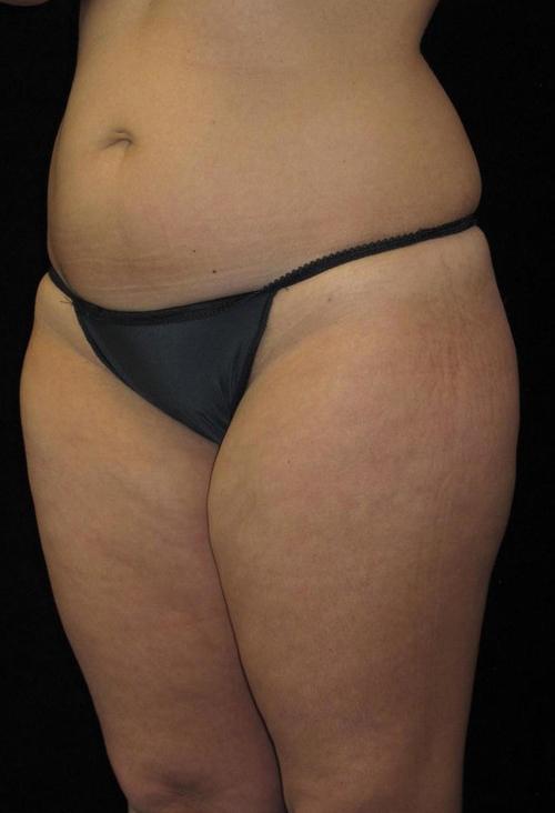 Liposuction Patient Photo - Case 69 - before view-1
