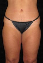 Liposuction - Case 69 - After