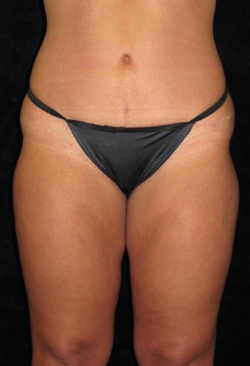 Liposuction Patient Photo - Case 69 - after view