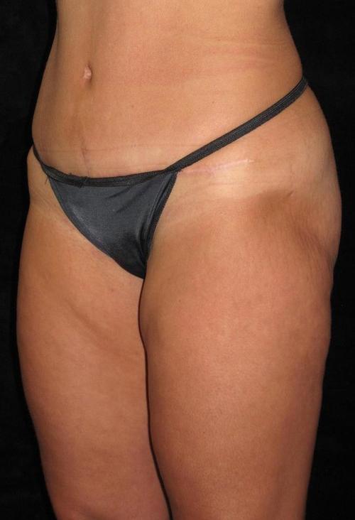 Liposuction Patient Photo - Case 69 - after view-1