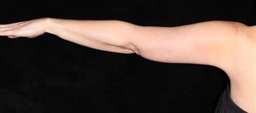 Arm Lift Patient Photo - Case 211 - after view-1