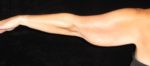 Arm Lift before and after results - Nashville patient - Before
