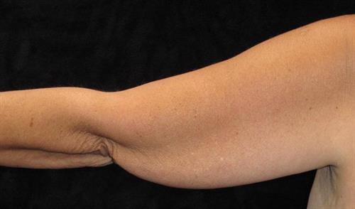 Arm Lift Patient Photo - Case 210 - before view-1
