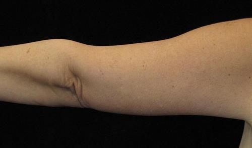 Arm Lift Patient Photo - Case 210 - after view-1