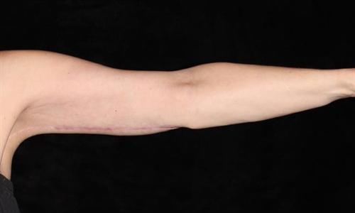 Arm Lift Patient Photo - Case 187 - after view