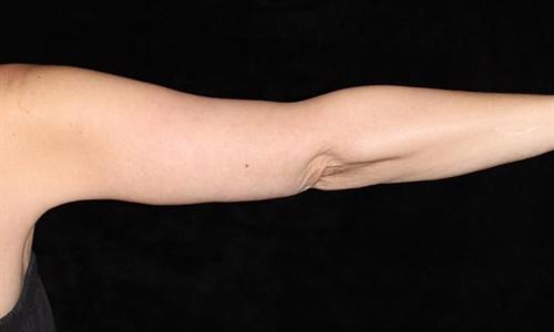 Arm Lift Patient Photo - Case 187 - after view-1