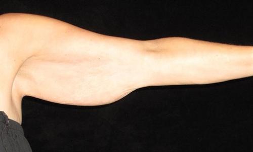 Arm Lift Patient Photo - Case 187 - before view-0