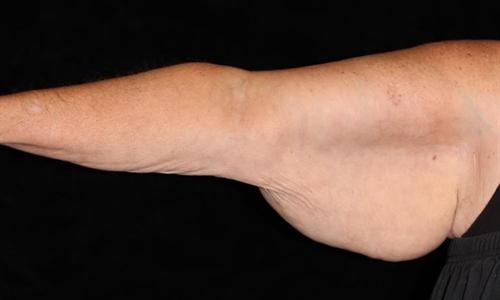 Arm Lift Patient Photo - Case 193 - before view-