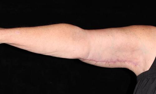 Arm Lift Patient Photo - Case 193 - after view
