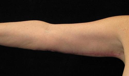 Arm Lift Patient Photo - Case 195 - after view