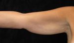 Arm Lift - Case 195 - Before