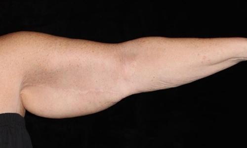 Arm Lift Patient Photo - Case 176 - before view-