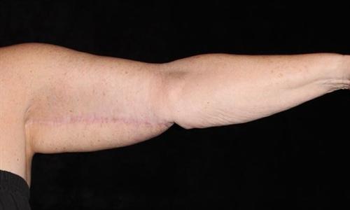 Arm Lift Patient Photo - Case 176 - after view-0