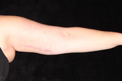 Arm Lift Patient Photo - Case 178 - after view