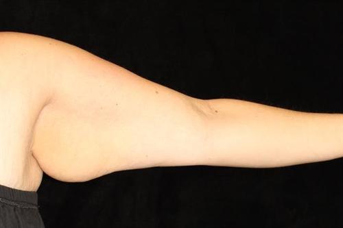 Arm Lift Patient Photo - Case 178 - before view-