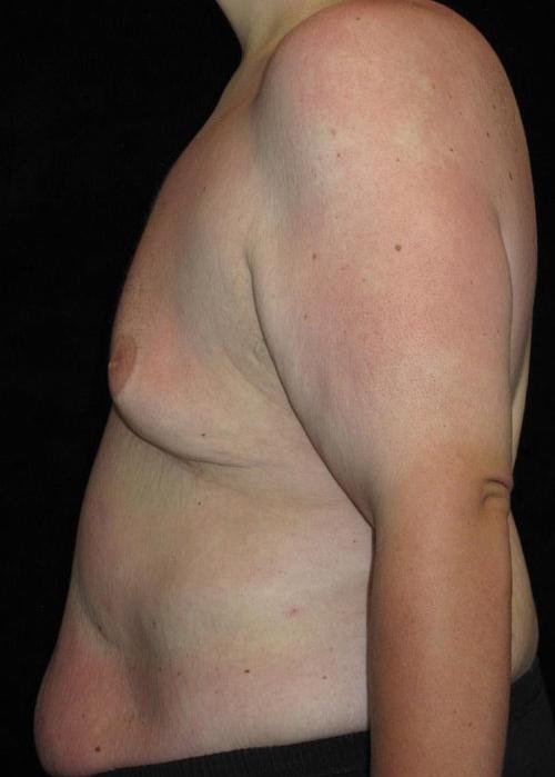 Male Body Contouring Patient Photo - Case 29 - before view-1