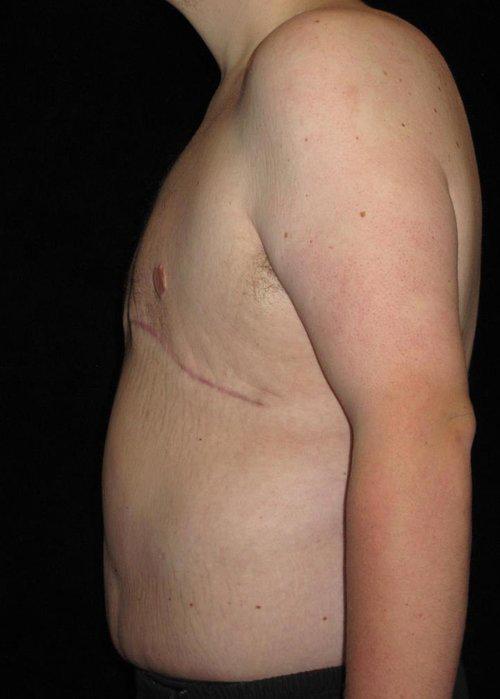 Male Body Contouring Patient Photo - Case 29 - after view-1