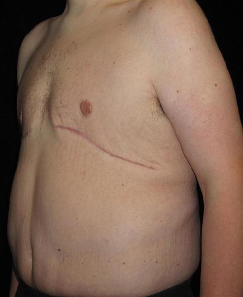 Male Body Contouring Patient Photo - Case 29 - after view